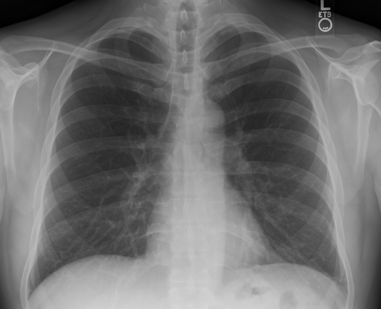 Chest X-ray on a reading workstation