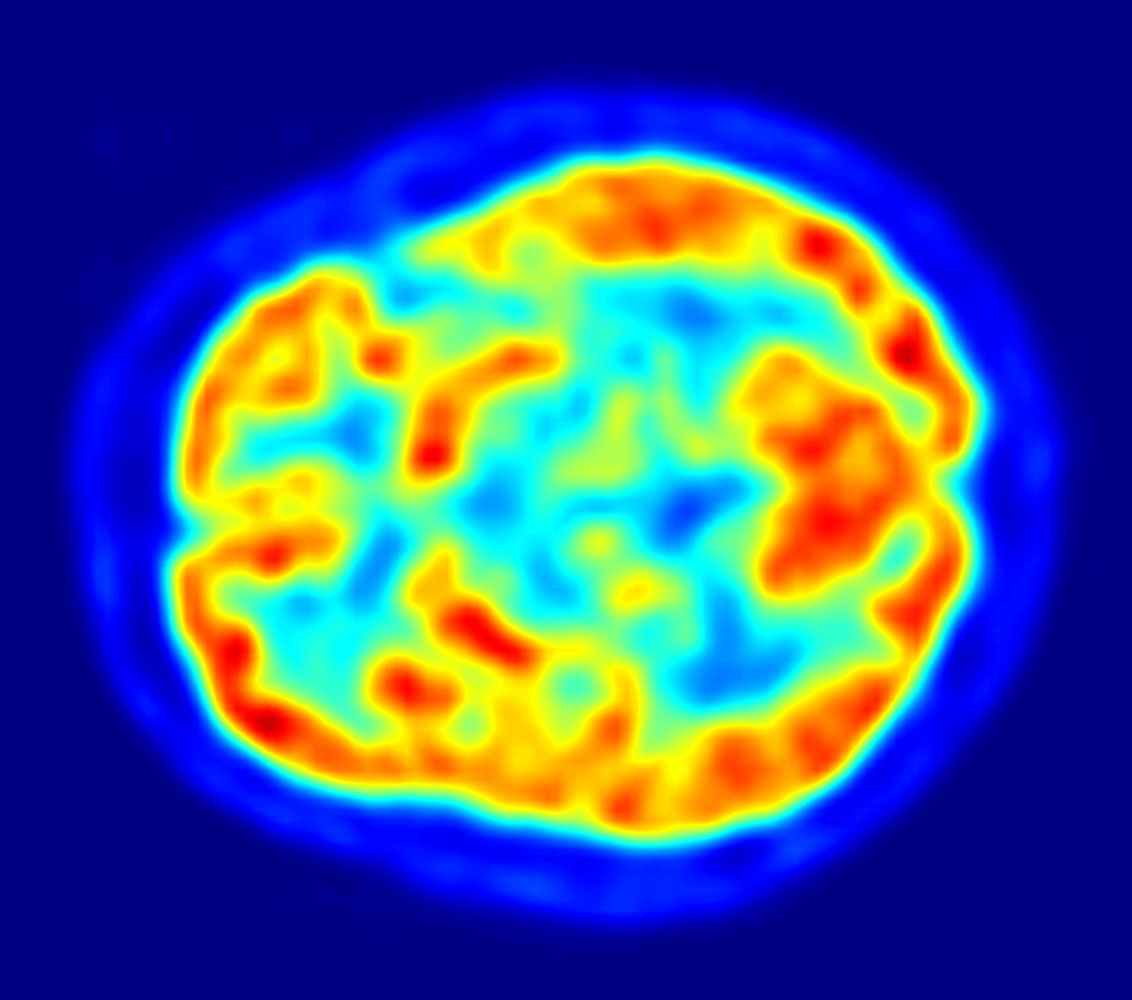 FDG PET brain study on a reading workstation